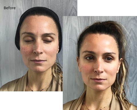 cryo facial before & after