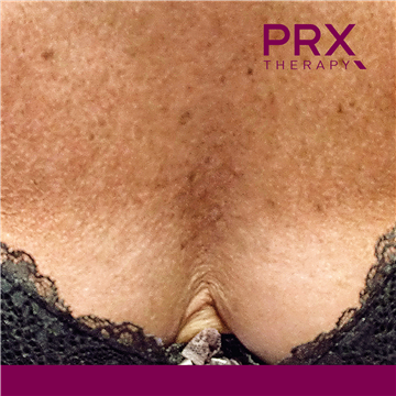 PRX Therapy for Decolletage - After
