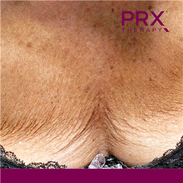PRX Therapy for Decolletage - Before