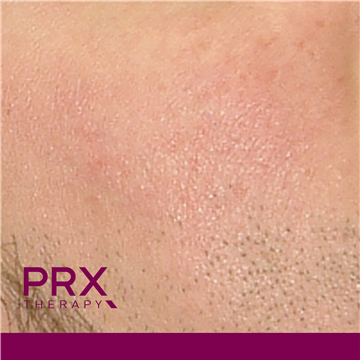 PRX Therapy for Scars - After