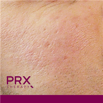 PRX Therapy for Scars - Before