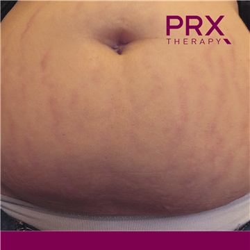 PRX Therapy for Stretch Marks - After