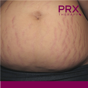 PRX Therapy for Stretch Marks - Before