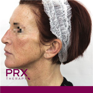 PRX Therapy for Face - After