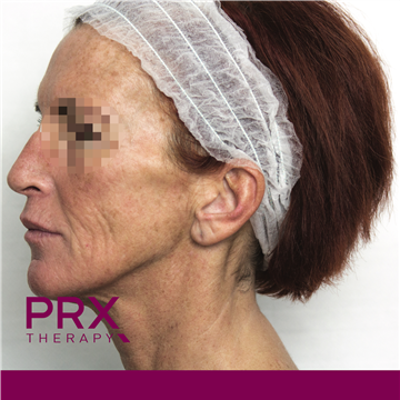 PRX Therapy for Face - Before