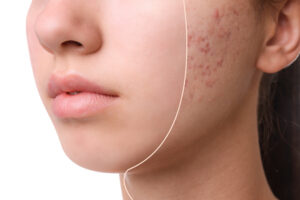 dermaplaning to reduce acne scarring