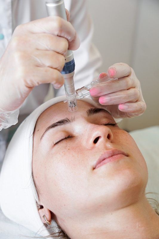 microneedling procedure