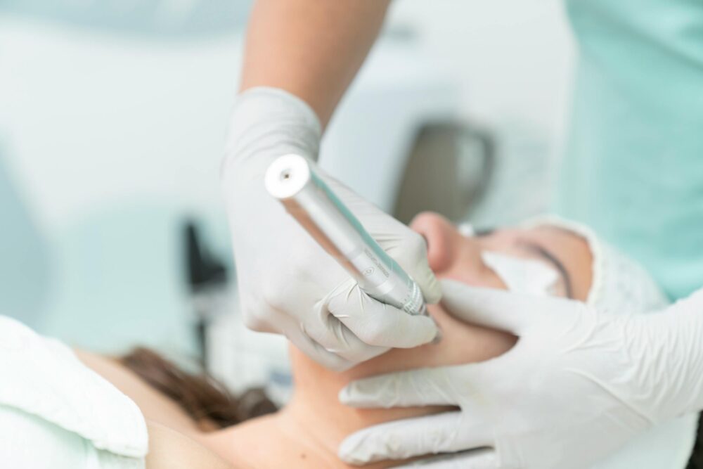 microneedling microneedling